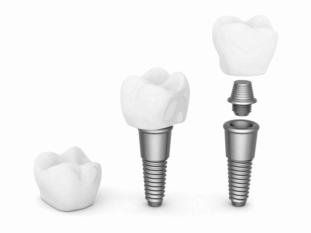 peur des implants dentaires