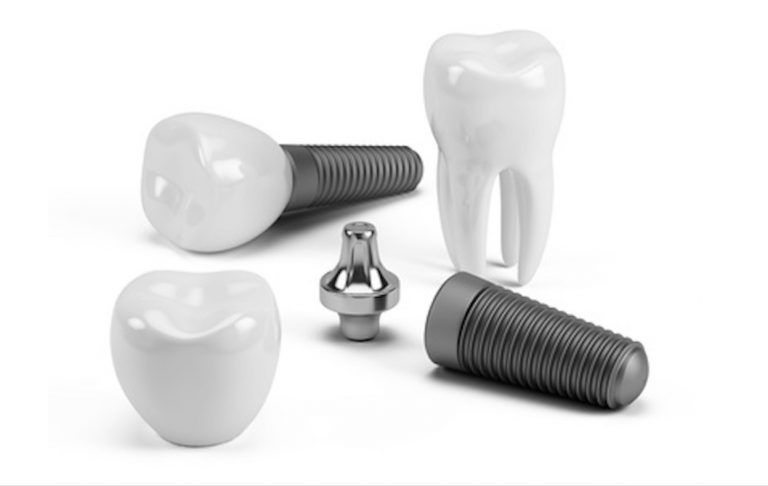 tarif d'un implant dentaire