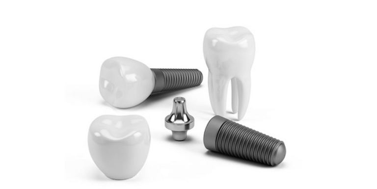 tarif implant dentaire