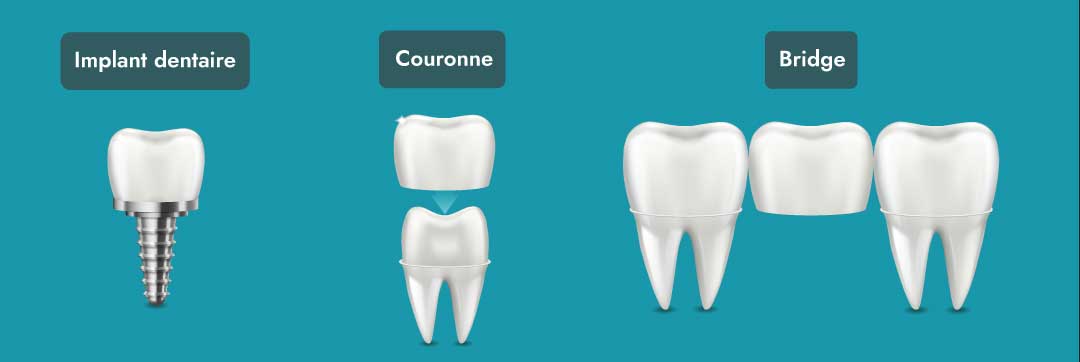 différentes prothèses dentaires