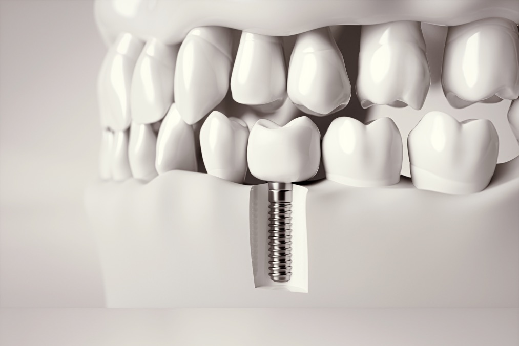 implant dentaire unitaire