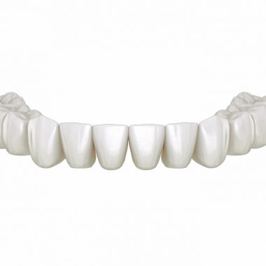 bridge complet 12 à 14 dents sans implants