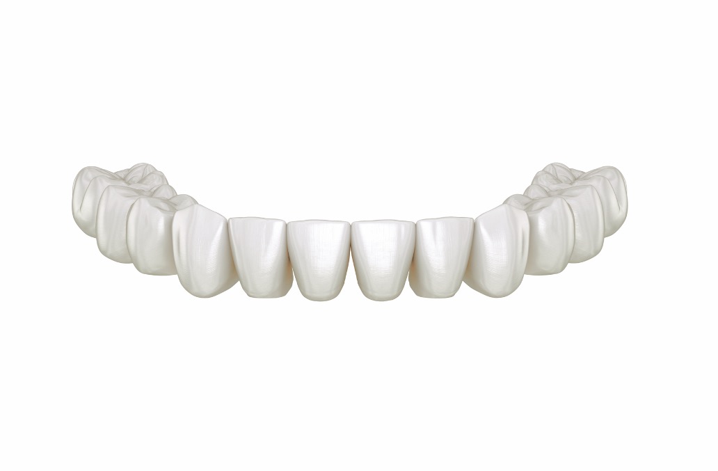 bridge complet 12 à 14 dents sans implants