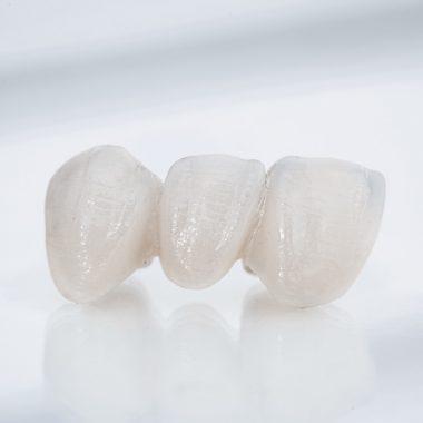 bridge dentaire 3 dents et plus sans implants