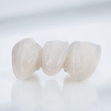 bridge de 3 dents et plus sans implants