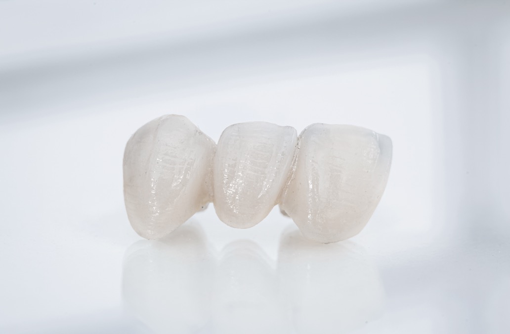 bridge dentaire 3 dents et plus sans implants