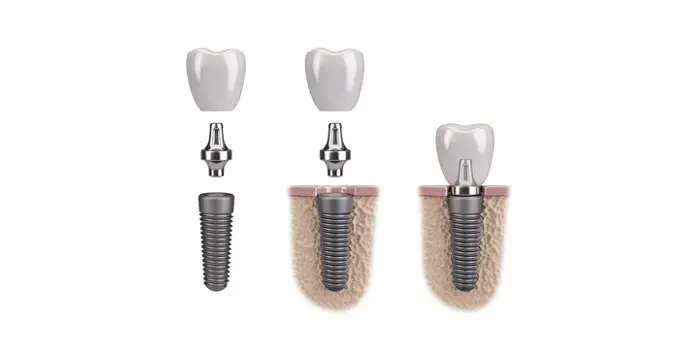 implants dentaires