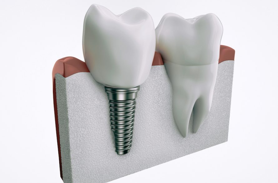 couronne sur implant dentaire
