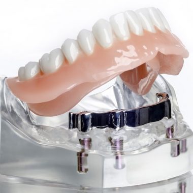 prothese sur implants et barre rétention
