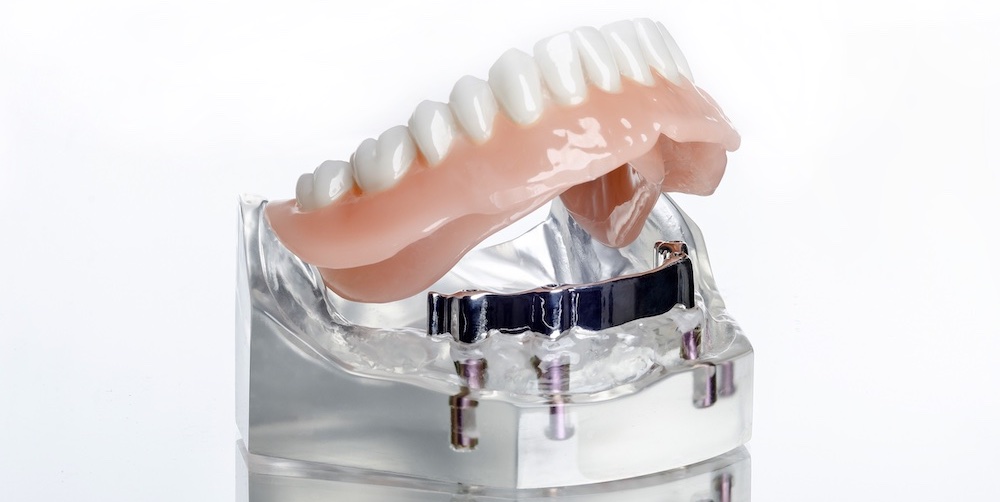 prothese sur implants et barre rétention