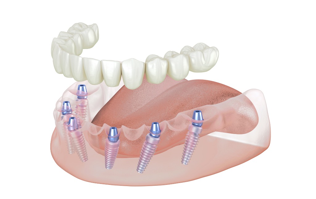 solution fixe collée sur 6 à 8 implants