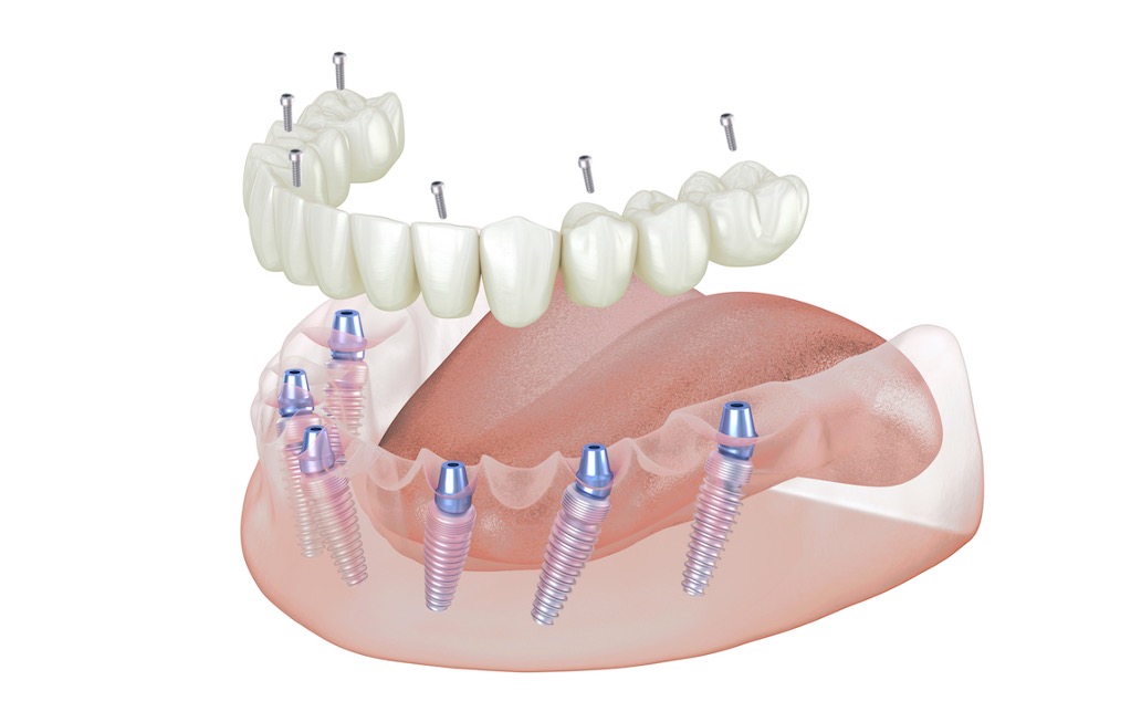 solution fixe transvissée sur 6 à 8 implants