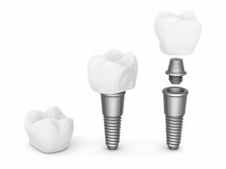 prix implant dentaire