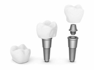 prix implant dentaire