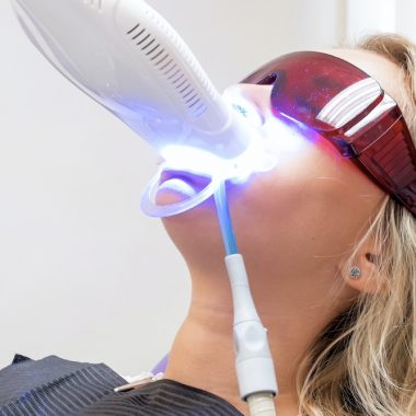 blanchiment des dents