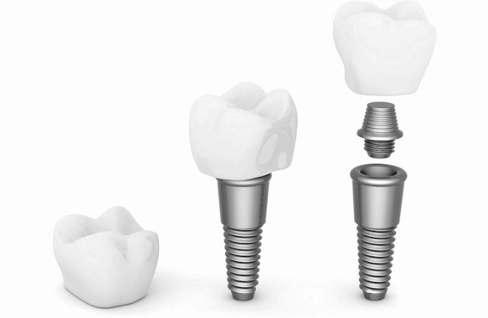 implants dentaires