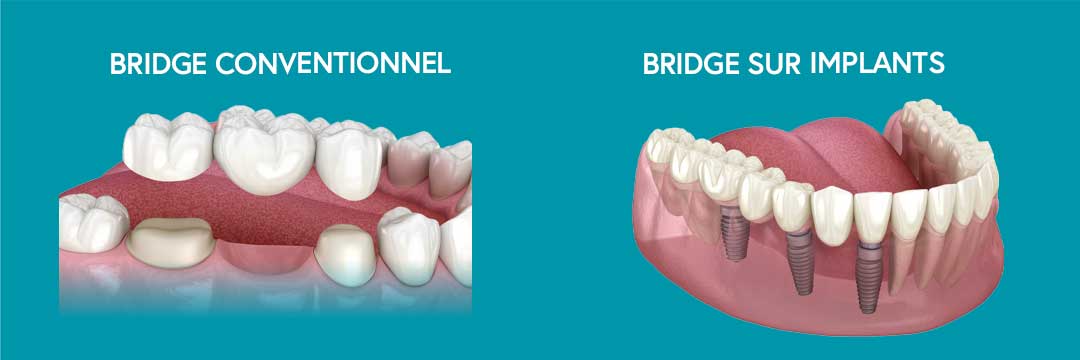 bridge dentaire conventionnel