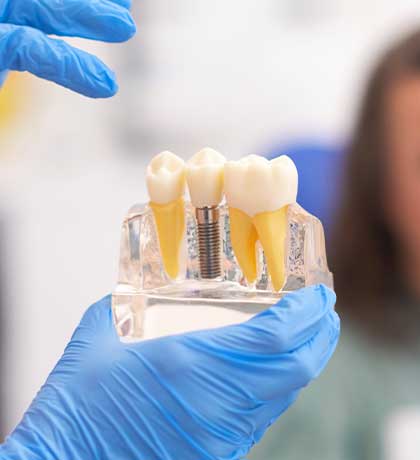 Implants dentaires en Hongrie
