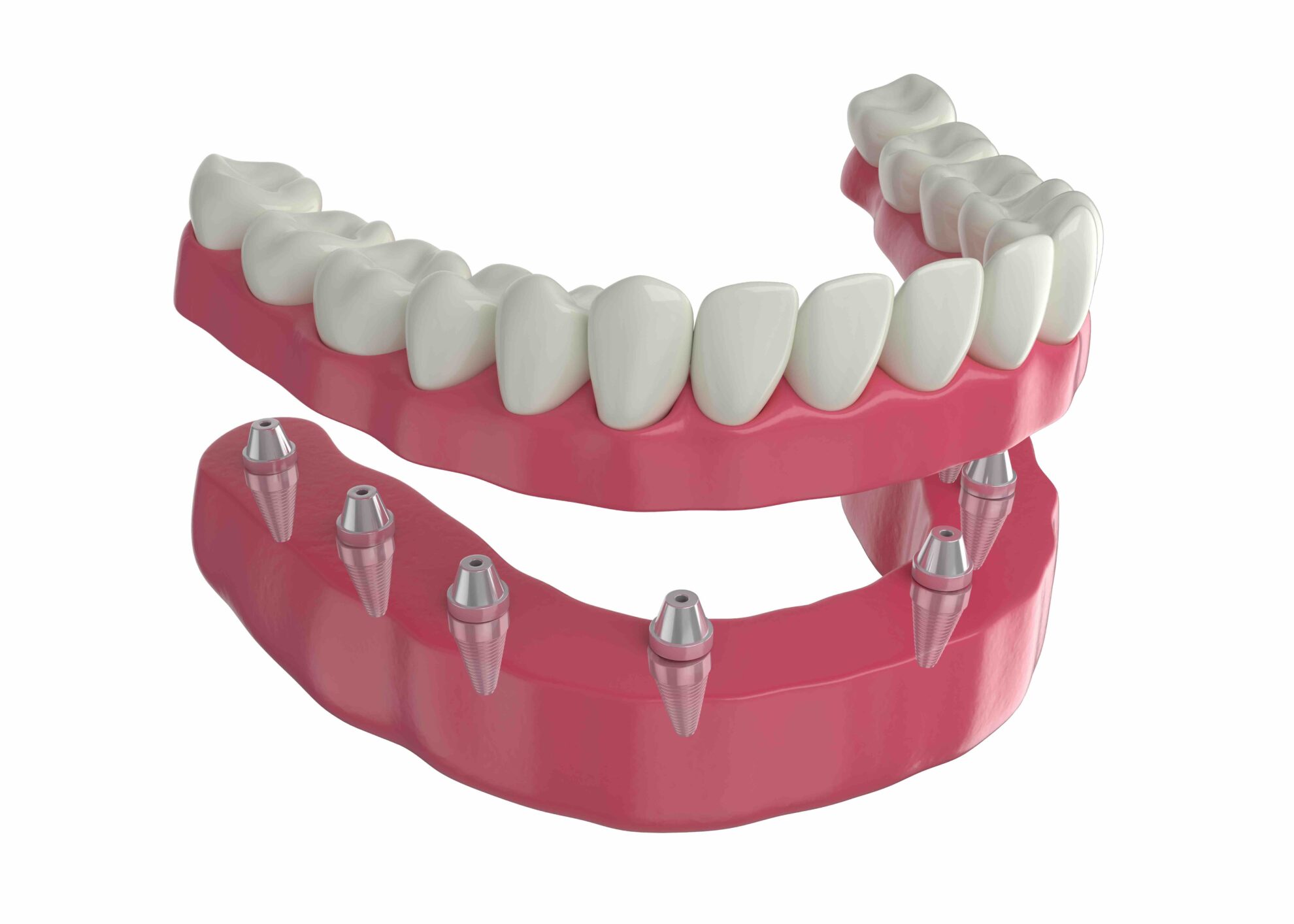 prothese dentaire sur implants