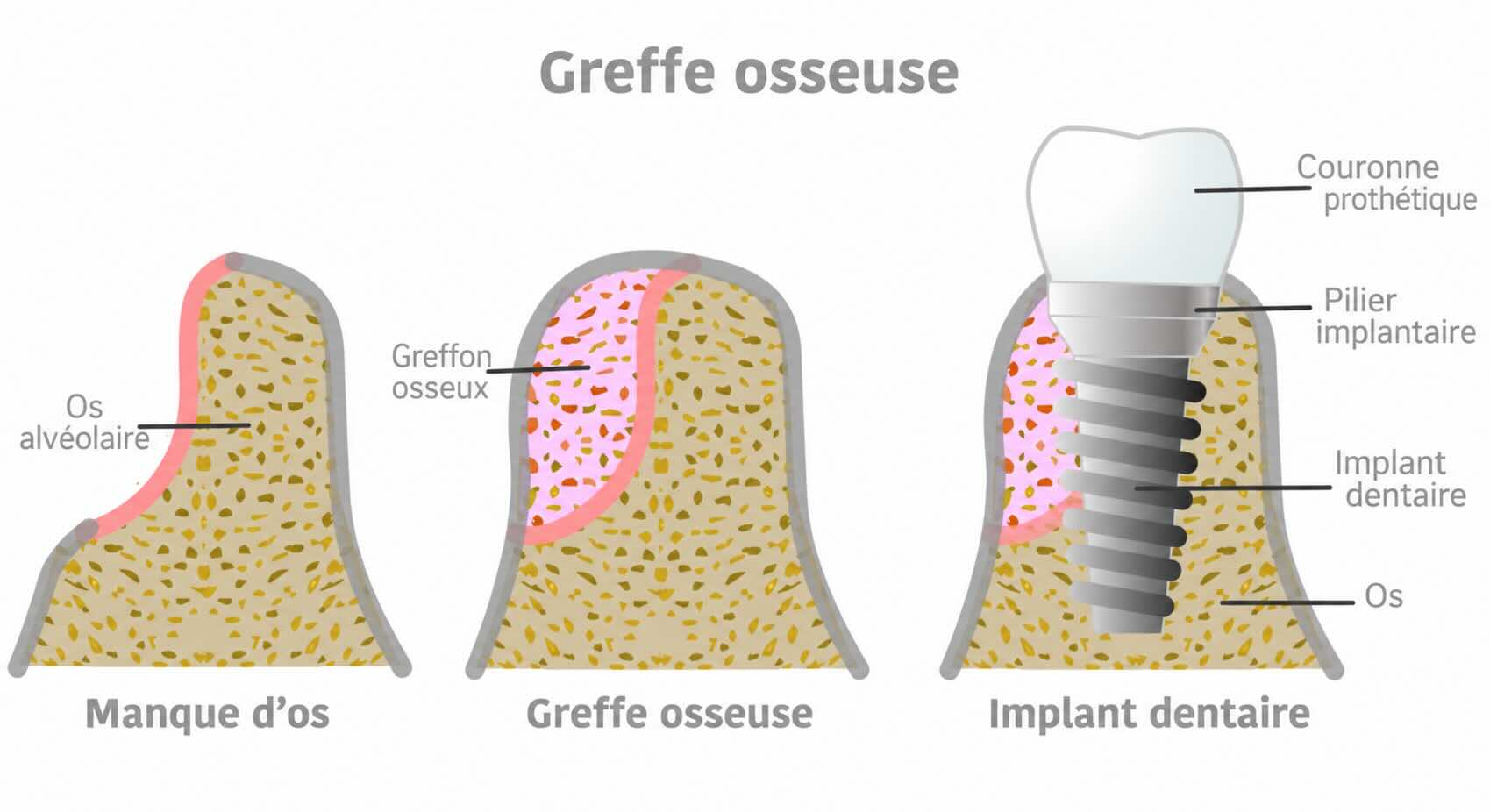 les étapes d'une greffe osseuse dentaire pour implants